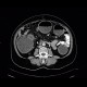 Carcinoma of sigmoid colon, large bowel obstruction, ileus: CT - Computed tomography